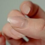 Ongle fendu verticalement