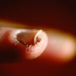 Ongle se fonde au même endroit